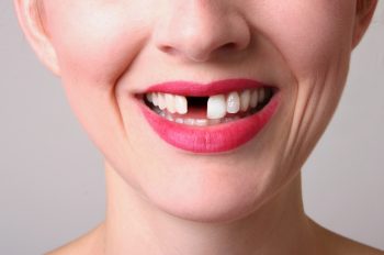 Calgary, Alberta dentist, Dr. Crawford of Calgary Dental House, talks about missing teeth – why you should replace them and the best ways to do so.